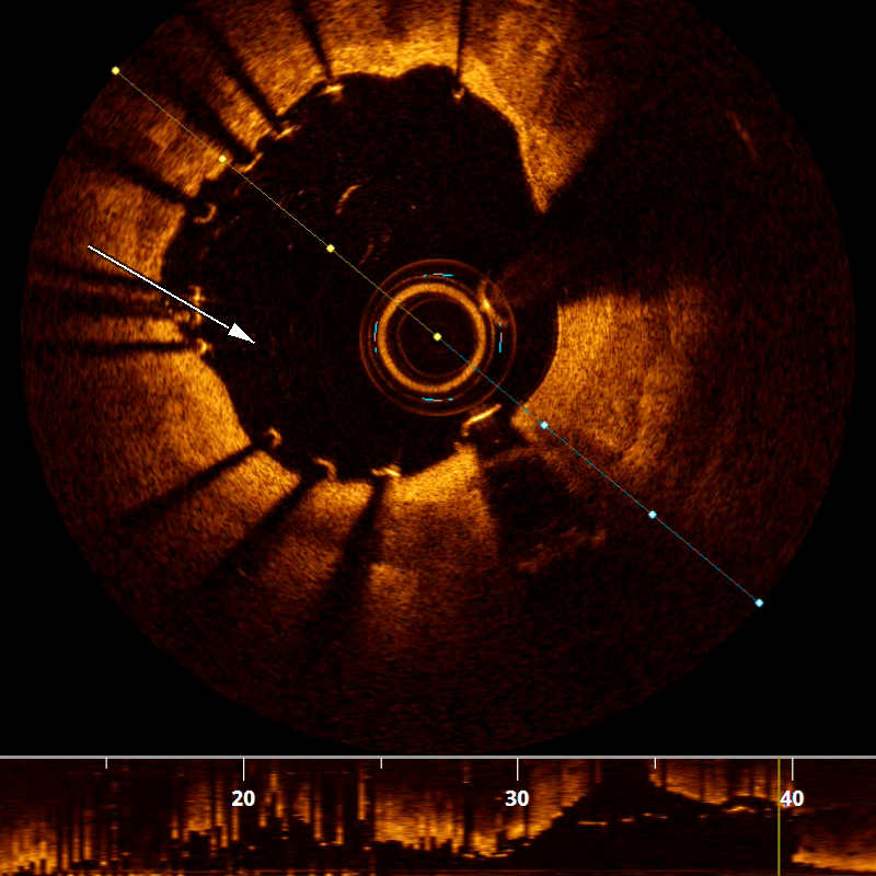 Stent sonrası OCT. İyi apoze stent strutları; geniş, yuvarlak ve düzgün lümen (ok).